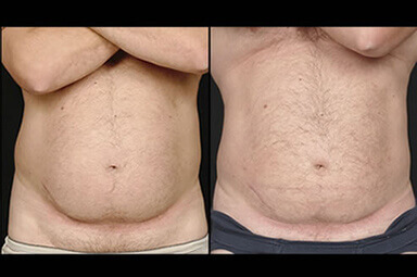 Aqualipo Stomach Liposuction, Male Patient
