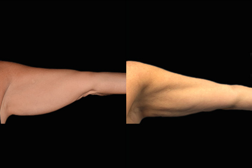 Bodytite Surgery For Arms Before & After Photo