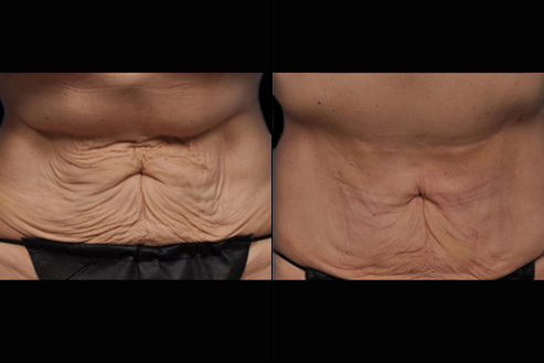Before And After Bodytite