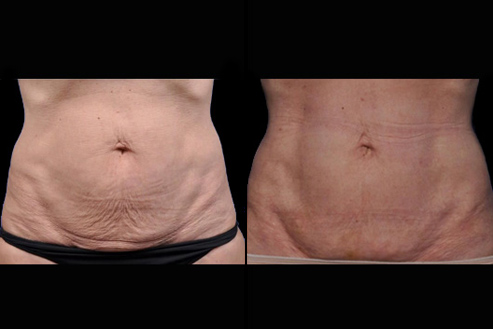 Bodytite Before And After Image