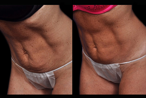 Bodytite Before & After Image