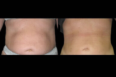 Aqualipo Stomach Liposuction Results