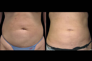 Stomach Lipo Before and After Results