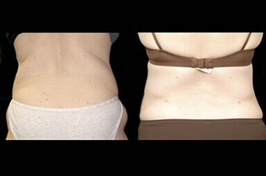 Aqualipo Stomach Lipo Before and After