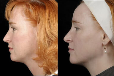 Aqualipo Neck Lipo Before and After