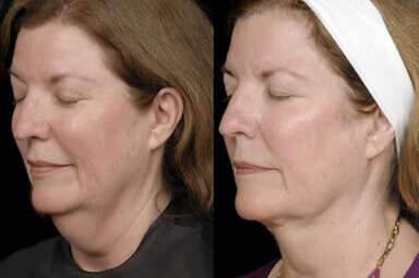 Aqualipo Neck Liposuction Before and After