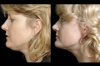 Chin Liposuction Before and After