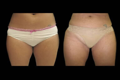 Aqualipo Leg Lipo Before and After