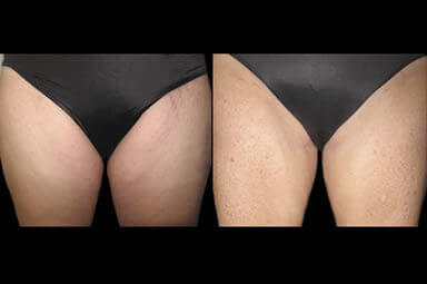 Leg Lipo Before and After