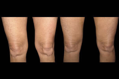 Aqualipo Thigh Liposuction Before And After