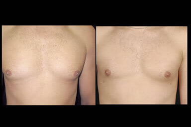 Aqualipo Male Breast Liposuction Before And After