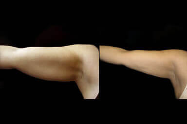 Arm Lipo Before and After