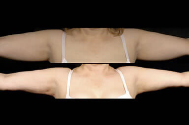 Arm Liposuction Before And After Photos