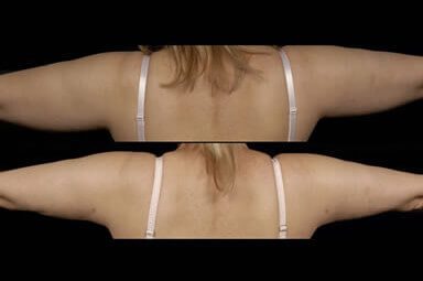 Arm Liposuction, Aqualipo Before & Afters