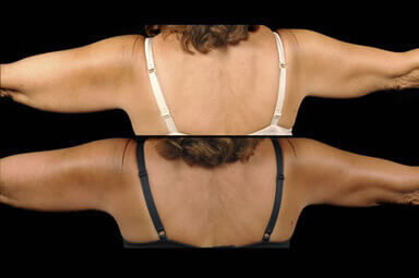 Aqualipo Arm Liposuction Before and After