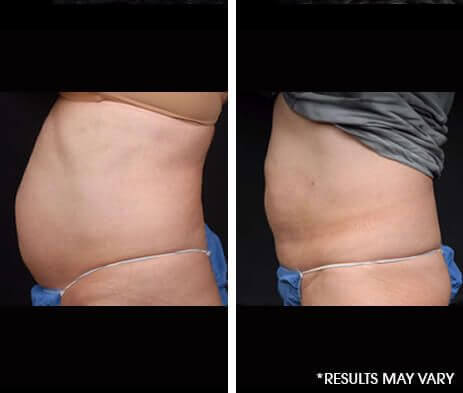 Water Assisted Lipo Before and After