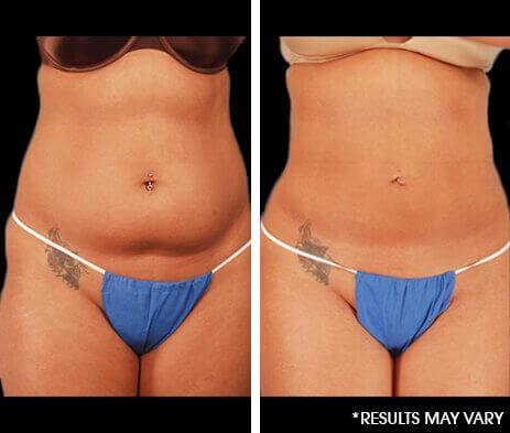 Body Sculpting before and after