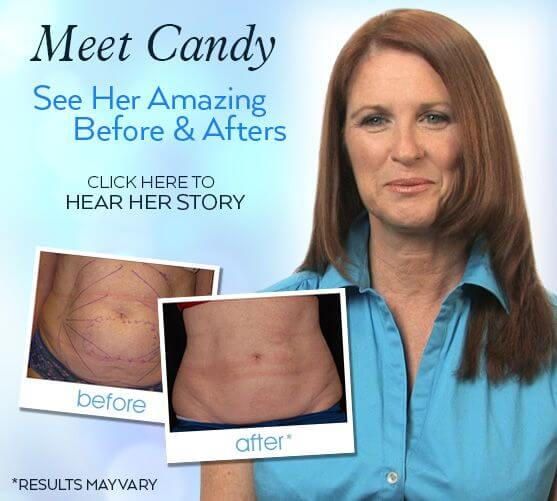 See Candy's Amazing Before & After Results
