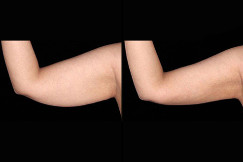 Bodytite Treatment Before & After Image