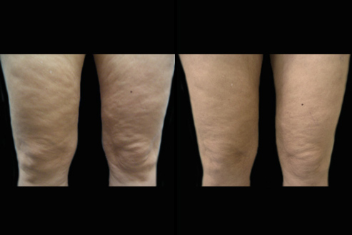 Before And After Bodytite Treatment