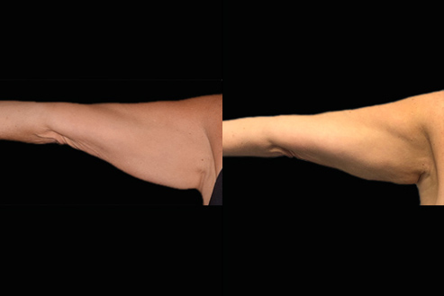 Bodytite Surgery For Arms Before And After Photo