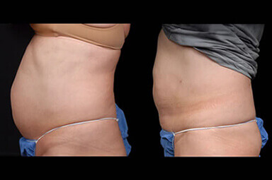 Stomach Lipo Before and After
