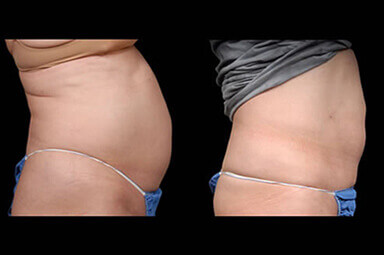 Aqualipo Stomach Liposuction Before and After