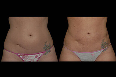 Stomach Liposuction Before and After