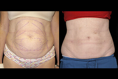 Stomach Lipo Before and After