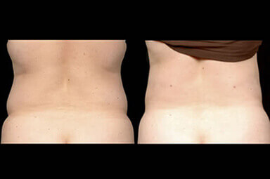 Aqualipo Stomach Liposuction Before and After