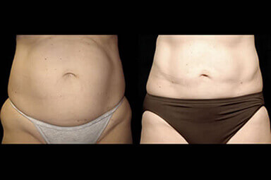 Stomach Liposuction Before and After Photos