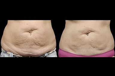 Stomach Liposuction Before and After