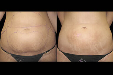 Aqualipo Stomach Lipo Results