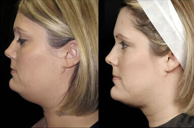 Aqualipo Chin Lipo Before and After