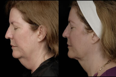 Neck Liposuction Before and After