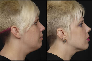 Chin Lipo Before and After