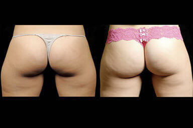 Aqualipo Leg Liposuction Before and After