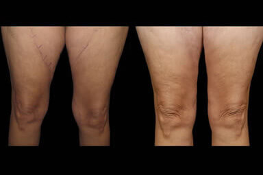 Leg Liposuction Before and After