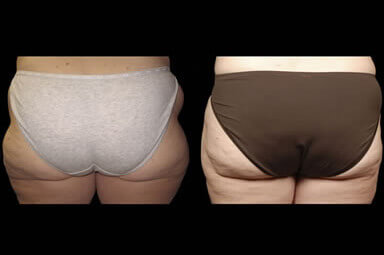 Thigh Liposuction Before And After