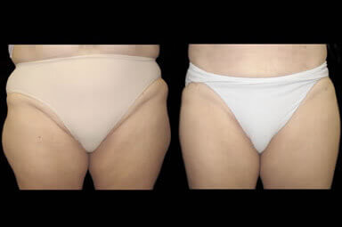 Leg Liposuction Before And After Photos