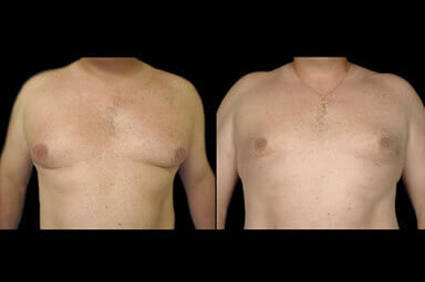 Male Breast Liposuction Before And After