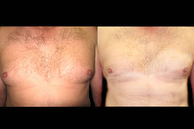 Male Breast Liposuction Before And After