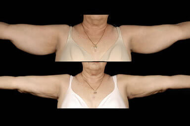 Arm Liposuction Before and After