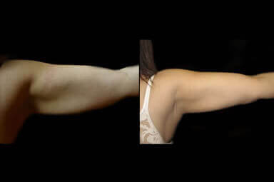 Aqualipo Arm Lipo Before and After