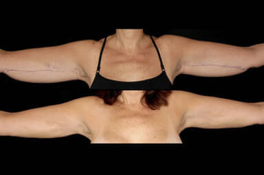 Aqualipo Arm Liposuction Before and After
