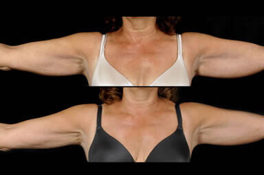 Arm Liposuction Before And After